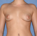 Breast Augmentation Implants