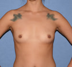 Breast Augmentation Implants