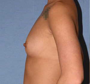 Breast Augmentation Implants