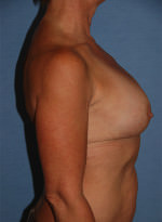 Breast Correction