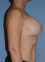 Breast Correction