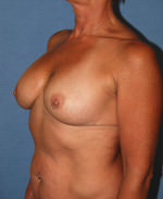 Breast Correction