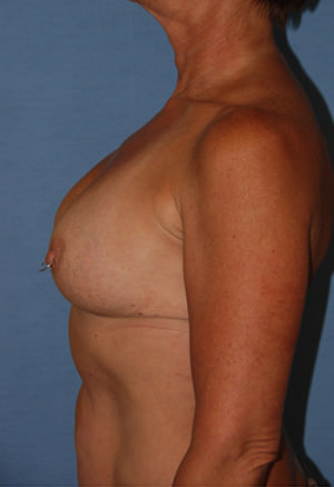 Breast Correction