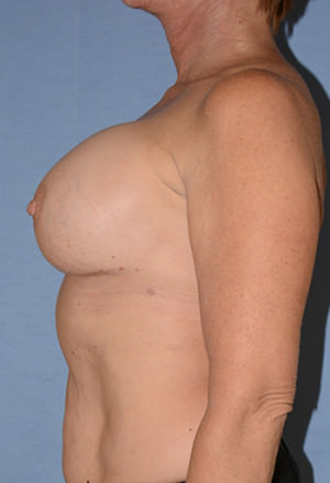 Breast Correction