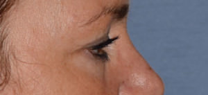 Eyelid Lift