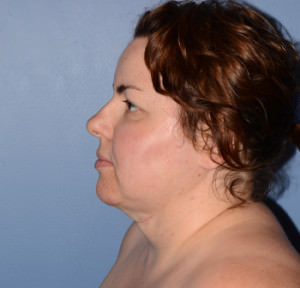 Chin and Jawline Liposuction