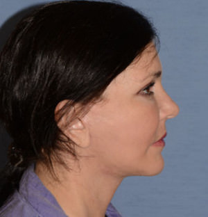 Facial Fat Transfer