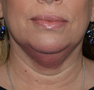 Kybella