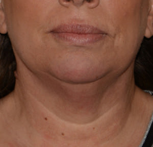 Kybella