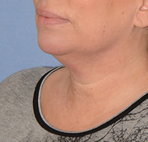 Kybella