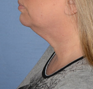 Kybella