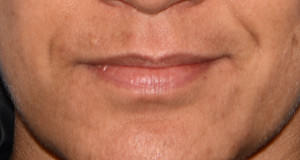 Lip Implants