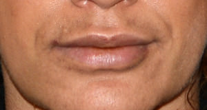 Lip Implants