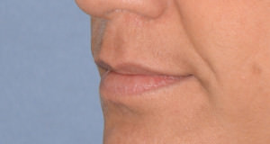 Lip Implants