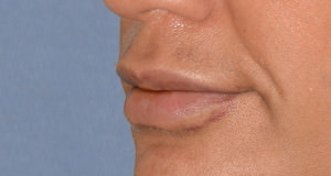 Lip Implants