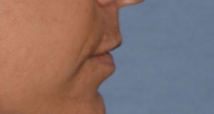 Lip Implants