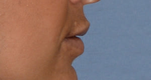 Lip Implants