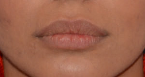 Lip Implants