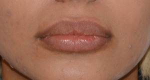 Lip Implants