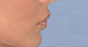 Lip Implants