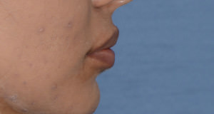 Lip Implants