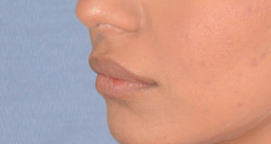 Lip Implants