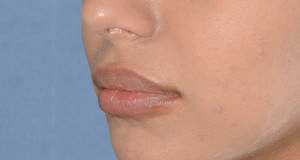 Lip Implants