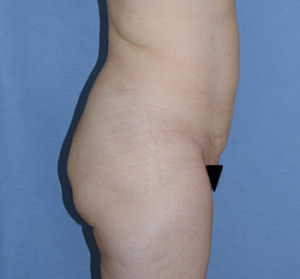 Liposuction