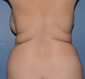 Liposuction