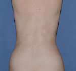 Liposuction