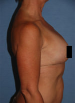 Liposuction