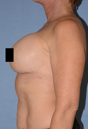 Liposuction