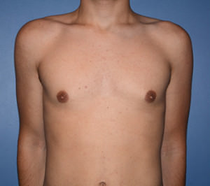 Male Breast Reduction Gynecomastia