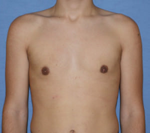 Male Breast Reduction Gynecomastia