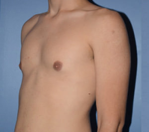 Male Breast Reduction Gynecomastia