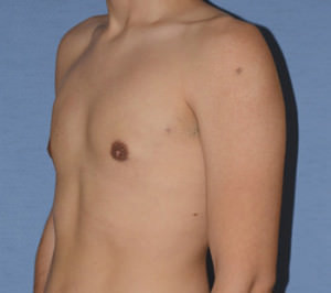 Male Breast Reduction Gynecomastia