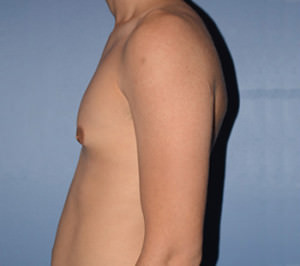 Male Breast Reduction Gynecomastia