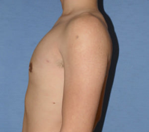 Male Breast Reduction Gynecomastia