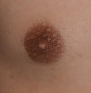 Male Breast Reduction Gynecomastia