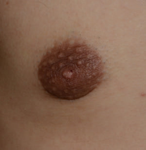 Male Breast Reduction Gynecomastia