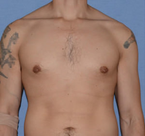 Male Breast Reduction Gynecomastia