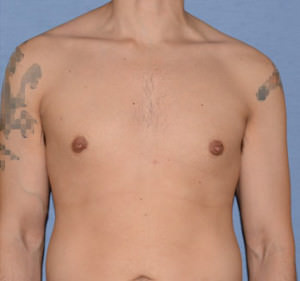 Male Breast Reduction Gynecomastia