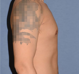 Male Breast Reduction Gynecomastia