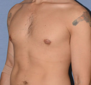 Male Breast Reduction Gynecomastia