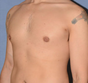 Male Breast Reduction Gynecomastia