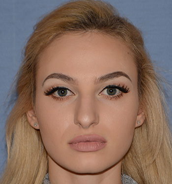 before nose rhinoplasty front view
