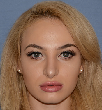 after nose rhinoplasty front view