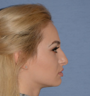 Rhinoplasty