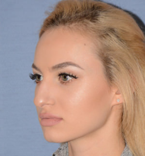 Rhinoplasty