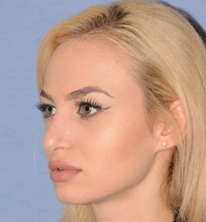 Rhinoplasty